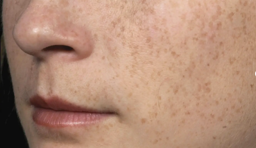Before Fraxel FTX treatment 2