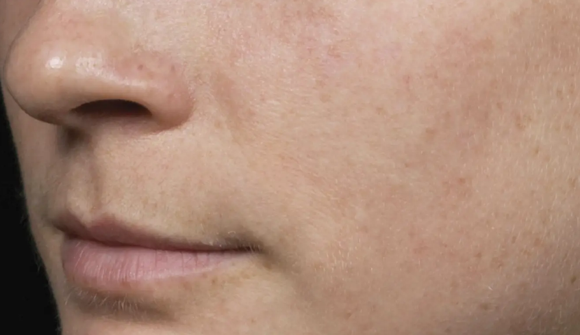 After Fraxel FTX treatment 2
