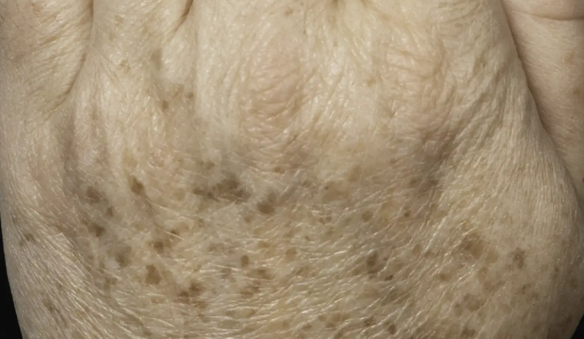 Before Fraxel FTX treatment 1