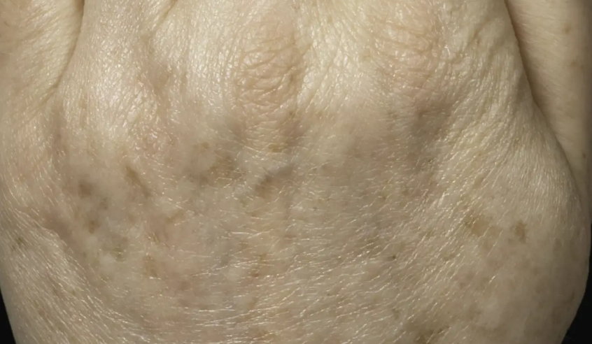After Fraxel FTX treatment 1
