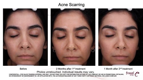 Fraxel FTX Laser